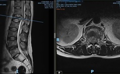Cứu bệnh nhân bị hội chứng chùm đuôi ngựa do tai nạn lao động