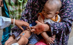 Gần 230 trẻ ở Bangladesh tử vong do bệnh sởi