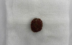 TP.HCM: Tin 'thuốc tan sỏi thận' trên mạng, người đàn ông tắc nghẽn đường niệu