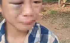 Xác minh vụ bé trai nghi bị mẹ kế và bố đánh đập