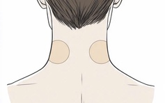Bé gái 7 tuổi loạn thần cấp tính sau khi dùng miếng dán chống say tàu xe