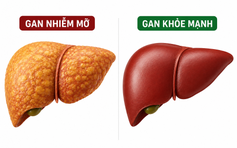Loại vitamin quen thuộc có thể là 'cứu tinh' cho gan nhiễm mỡ