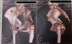 TP.HCM: Giải mã gien phát hiện bé gái mắc hội chứng người hóa đá cực hiếm gặp