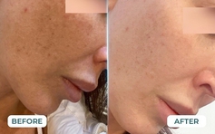 Top 7 kem mờ nám chân sâu giúp da trắng hồng rạng rỡ sau khoảng 4 tuần