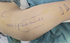 Bé 14 tuổi mắc bệnh lý chất trắng ở não, thoát cảnh ‘năm nào cũng phải mổ’