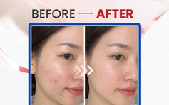 Top 5 kem chấm mụn giúp mụn viêm sưng xẹp sau khoảng 1 đêm ngừa sẹo thâm