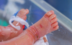 Bé trai sinh non mắc bệnh vảy cá hiếm gặp, hồi phục sau 12 ngày điều trị