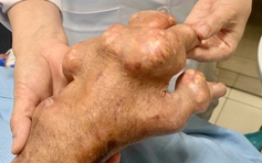 Các thực phẩm giúp kiểm soát axít uric ở người bệnh gout