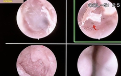 Bọ chét 'làm tổ' trên người: Dấu hiệu và cách phòng tránh