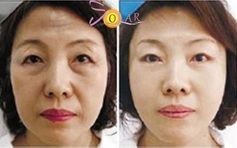 Khuyến mãi ‘sốc’ 75% giải pháp Ultherapy, New Theramge nâng cơ mặt, xóa nhăn