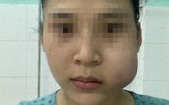 Một bên má của cô gái 23 tuổi sưng to như quả cam sau tiêm filler Hàn Quốc