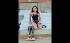 Cô bé khuyết chân vượt qua nghịch cảnh