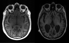 Tìm ra nguyên nhân phát triển bệnh Alzheimer