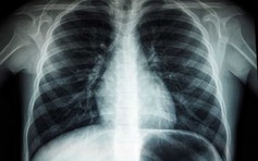Thấy gì trong phim chụp phổi của bệnh nhân Covid-19 vào 1 năm sau?