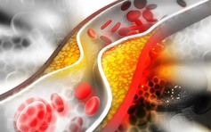 Chuyên gia: Cách ăn tốt nhất nếu bạn có mức cholesterol cao