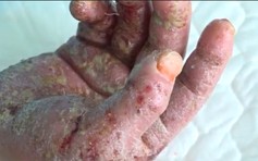Chích vỡ mụn nước ở lòng bàn tay, bệnh nhân bị nhiễm trùng nặng