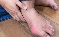 Nỗi lo bệnh gout những ngày tết