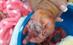 Tai nạn thương tâm: Bé trai bị dây sên xe gắn máy cắt đứt lìa bàn tay