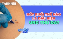 Cảnh báo những nốt ruồi bất thường là dấu hiệu của ung thư da