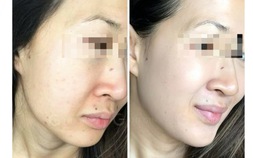 Liệu pháp peel da an toàn được chuyên gia tin tưởng, thay thế filler và botox