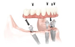 Trồng răng Implant toàn hàm, nâng cao sức khỏe, nâng cao chất lượng cuộc sống