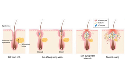 Gel chấm mụn nên dùng khi nào? Những lưu ý trước khi chấm mụn