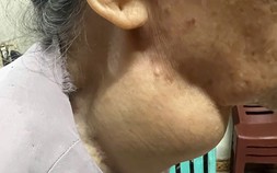 Vinmec Hạ Long loại bỏ khối u giáp khổng lồ 18 năm của cụ bà 88 tuổi