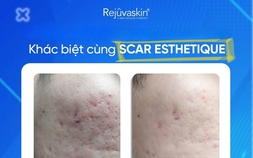Kem mờ sẹo rỗ nào hiệu quả với cả sẹo lâu năm mà không cần xâm lấn?