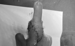 Người phụ nữ bị máy xay thịt nghiền nát 5 ngón tay