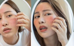 Điều gì có thể xảy ra nếu sử dụng quá liều retinol?