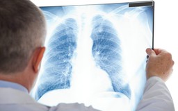 4 biểu hiện cảnh báo sớm ung thư phổi ở nam giới