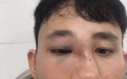 Học sinh lớp 10 bị gãy sống mũi sau vụ bạo lực học đường