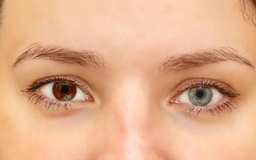 Những bệnh lý nào làm thay đổi mống mắt?