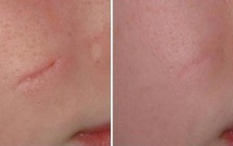 Review kem trị sẹo Scar Esthetique - Mua ở đâu?