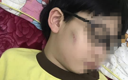 Quảng Ninh: Làm rõ vụ bé trai 8 tuổi bị mẹ đánh bầm tím vì chưa làm bài tập