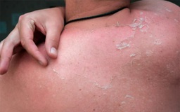 Bác sĩ đồng hành: Cách chăm sóc da bị cháy nắng