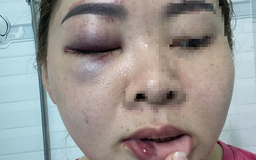 Đắk Lắk: Xác minh thông tin cô giáo mầm non bị chồng đánh nhập viện