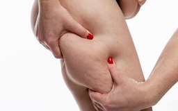 Mắc bệnh hiếm, cô gái phải hút 6,5 lít mỡ từ chân