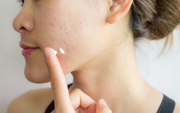 Salicylic Acid là gì? Công dụng và cách sử dụng hiệu quả ngăn ngừa kích ứng