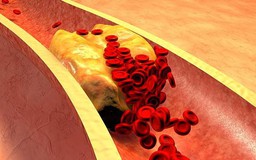Bị cholesterol cao, ăn gì là tốt nhất?