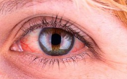 Vì sao nên ngủ riêng, cách ly tương đối khi đau mắt đỏ?