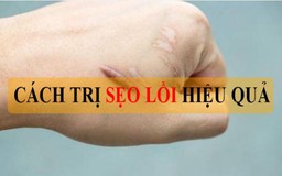 Top 10 cách trị sẹo lồi hiệu quả bất chấp tuổi sẹo