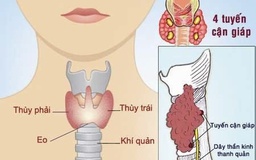 Gia tăng ca mắc ung thư tuyến giáp