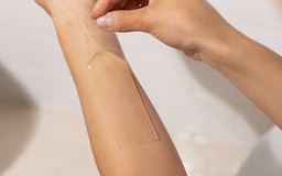 Miếng dán Silicone Y tế và Steroid trị sẹo lồi, nên dùng loại nào?