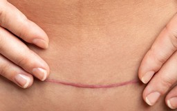 Sẹo phẫu thuật tạo thành bụng: Nguyên nhân và cách điều trị hiệu quả ngay tại nhà