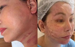 Nguyên nhân và cách khắc phục sẹo xấu trong phẫu thuật căng da mặt như thế nào?