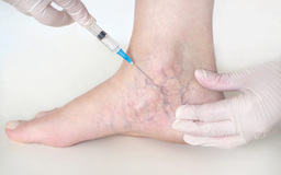 Giãn tĩnh mạch chân: Triệu chứng, nguyên nhân và phương pháp điều trị