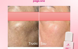 Review serum trị nám Page One có thật sự tốt không? Mua ở đâu chính hãng?