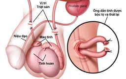 Vợ có bầu sau khi chồng đã thắt ống dẫn tinh