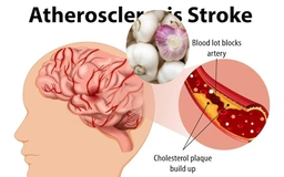 Ngày mới với tin tức sức khỏe: Phát hiện cách tỏi ngăn ngừa đột quỵ